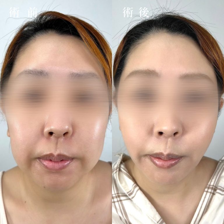 TCB式小顔脂肪吸引(担当医:真鍋 秀明 医師)の症例写真1