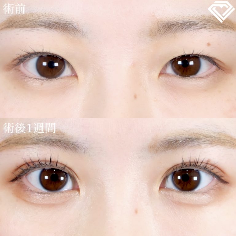 二重埋没法(担当医:TCB 医師)の症例写真1