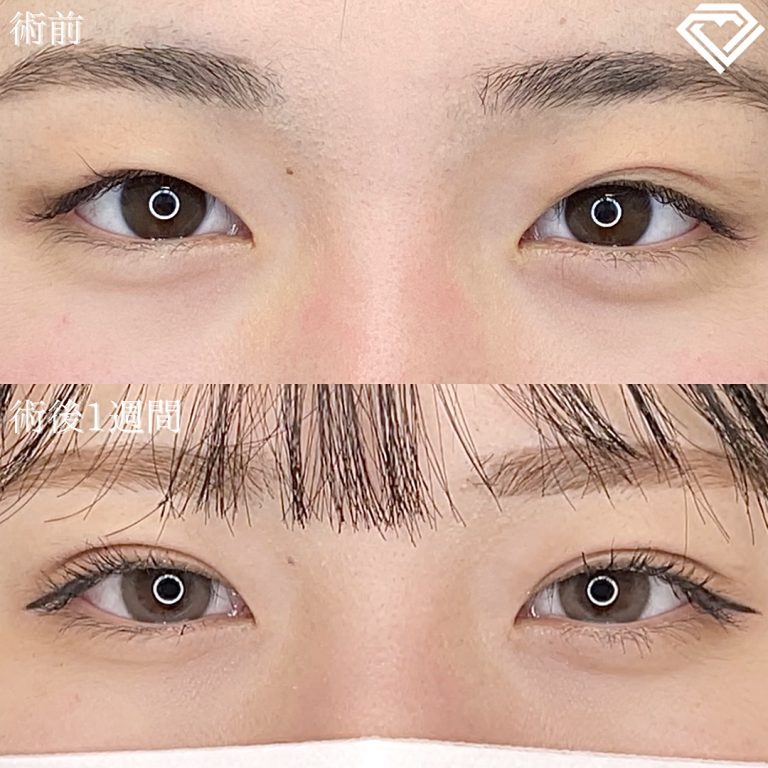 二重埋没法(担当医:TCB 医師)の症例写真1