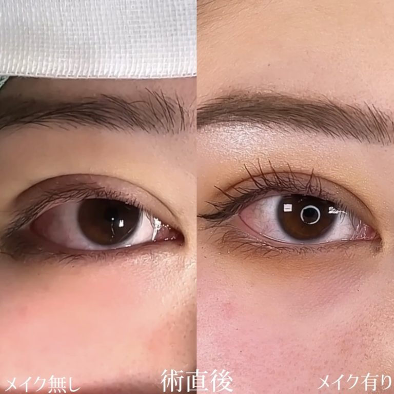 二重埋没法(担当医:TCB 医師)の症例写真3