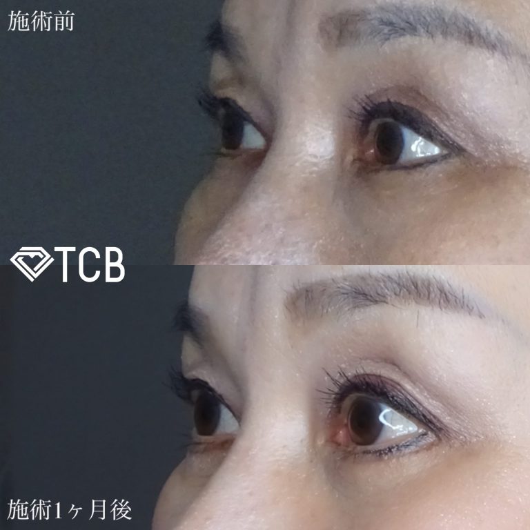 切開法による目の下のたるみ取り（下眼瞼除皺術）(担当医:佐藤 麻未 医師)の症例写真3