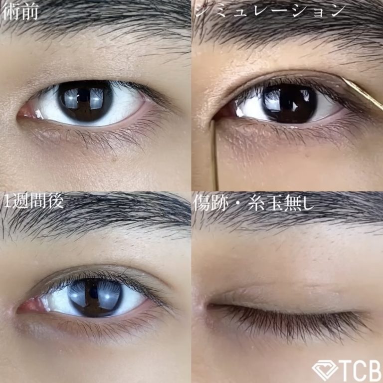 二重埋没法(担当医:TCB 医師)の症例写真1