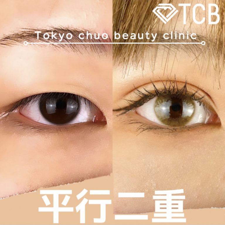 二重埋没法(担当医:TCB 医師)の症例写真1