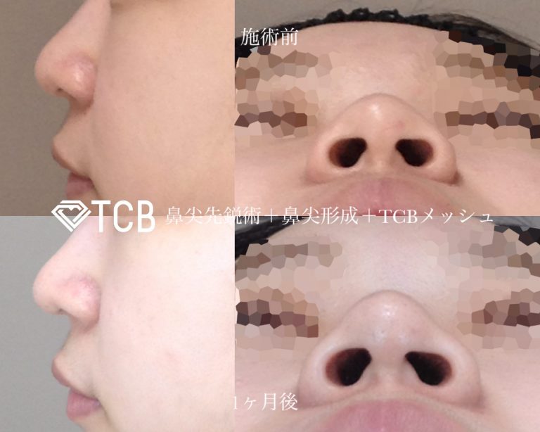 TCB式鼻先尖鋭術（だんご鼻解消）(担当医:寺西 宏王 医師)の症例写真1