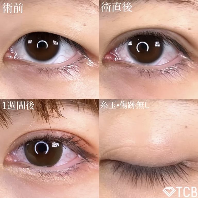 二重埋没法(担当医:TCB 医師)の症例写真1