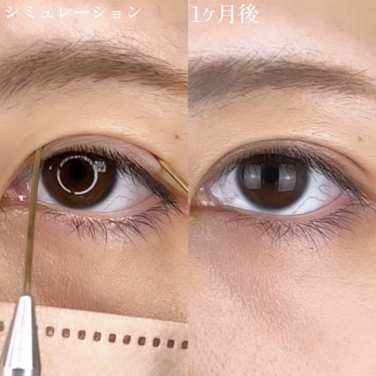 二重埋没法(担当医:TCB 医師)の症例写真3