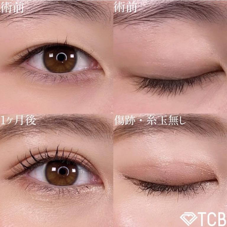 二重埋没法(担当医:TCB 医師)の症例写真2
