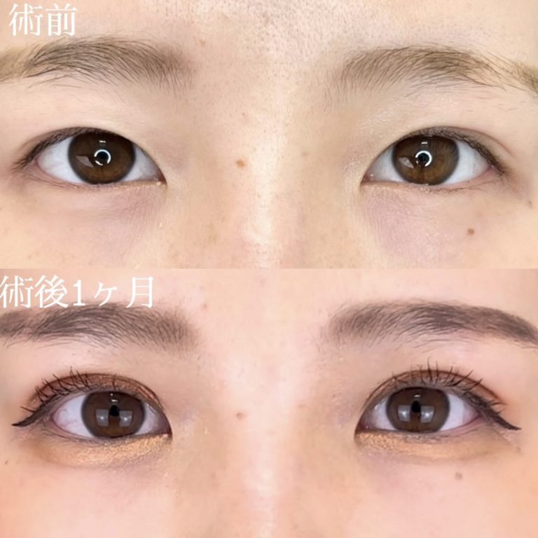 二重埋没法(担当医:TCB 医師)の症例写真1