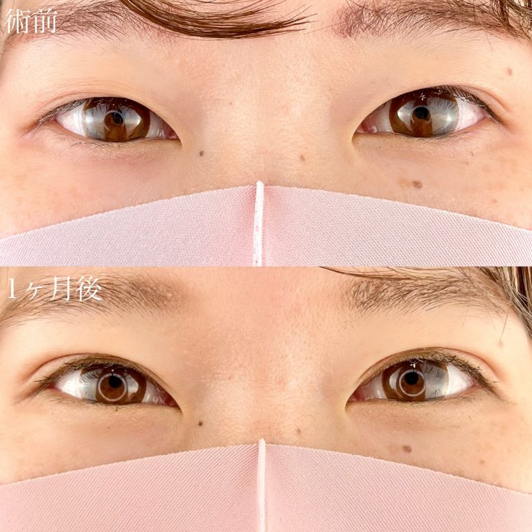 二重埋没法(担当医:TCB 医師)の症例写真1