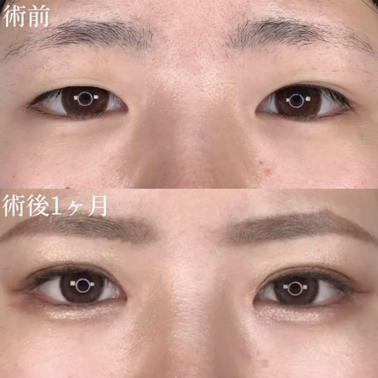 二重埋没法(担当医:TCB 医師)の症例写真1