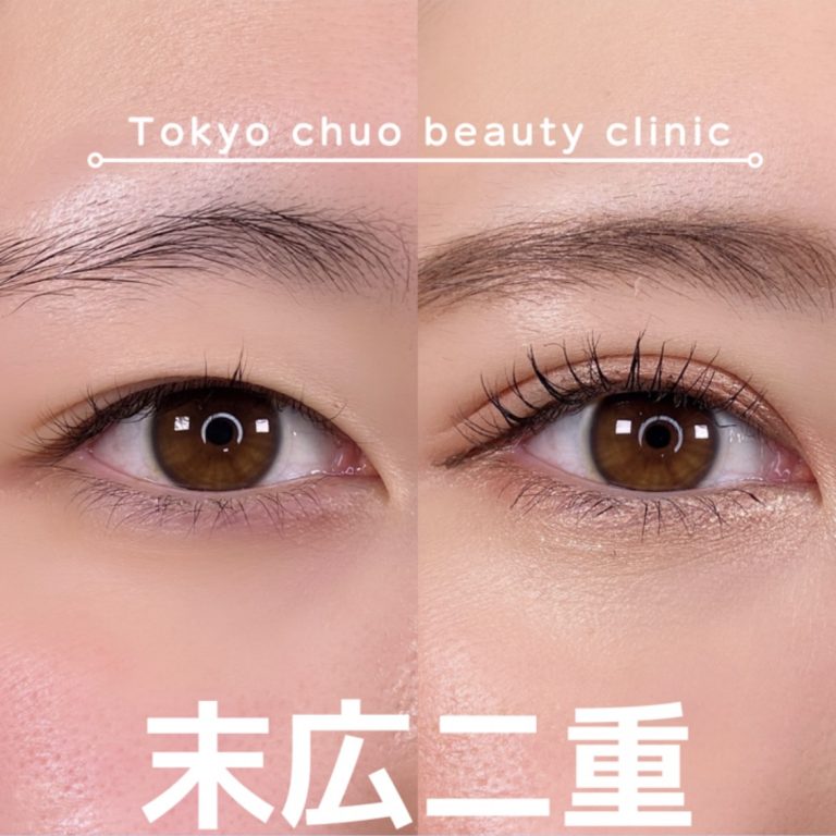二重埋没法(担当医:TCB 医師)の症例写真1