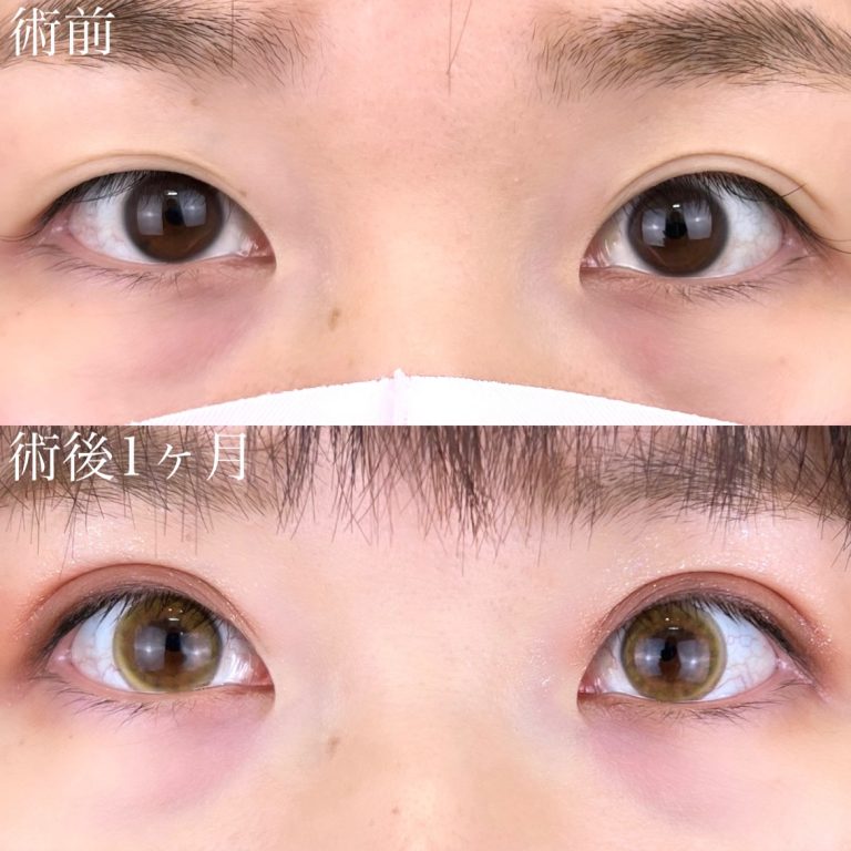 二重埋没法(担当医:TCB 医師)の症例写真1