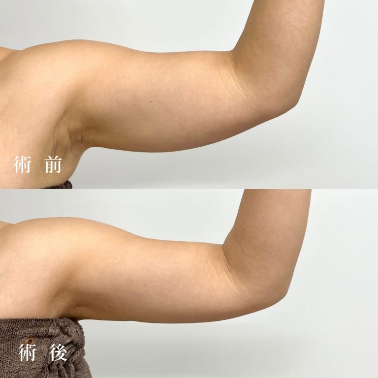 二の腕・肩 脂肪吸引(担当医:真鍋 秀明 医師)の症例写真1