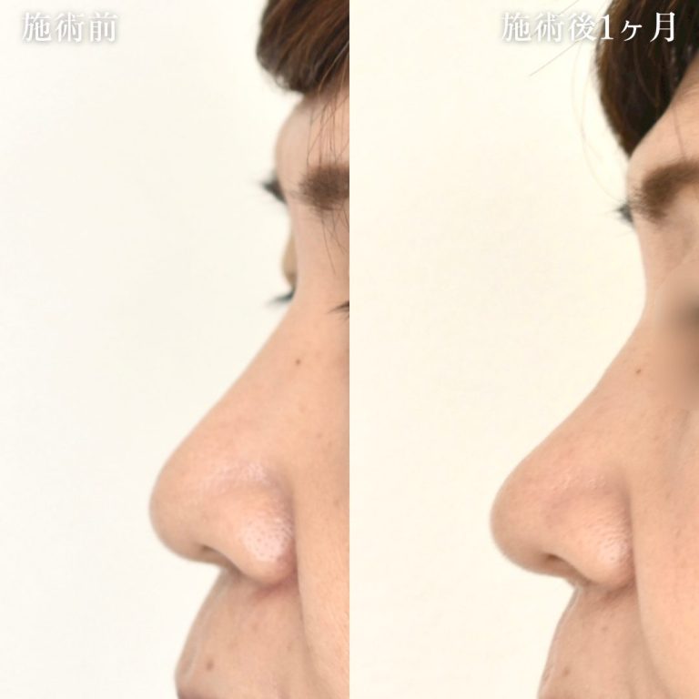 鼻尖形成(担当医:村田 将光 医師)の症例写真2