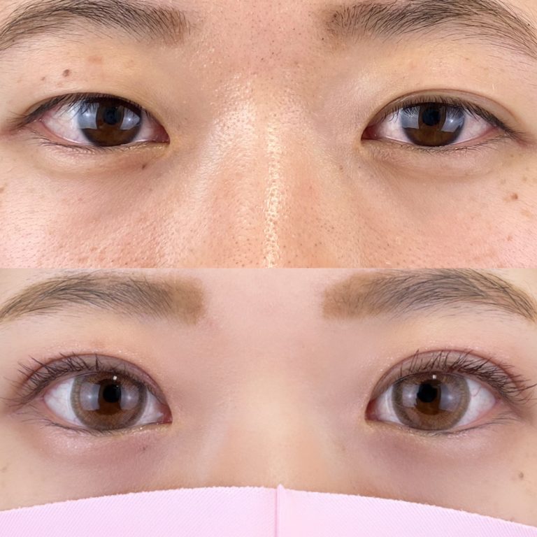 二重埋没法(担当医:TCB 医師)の症例写真1