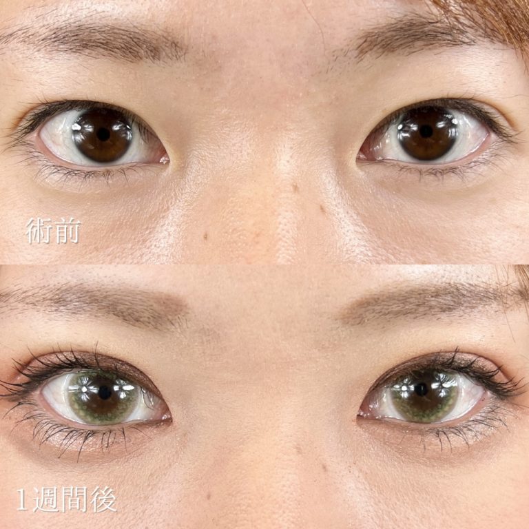 二重埋没法(担当医:TCB 医師)の症例写真1