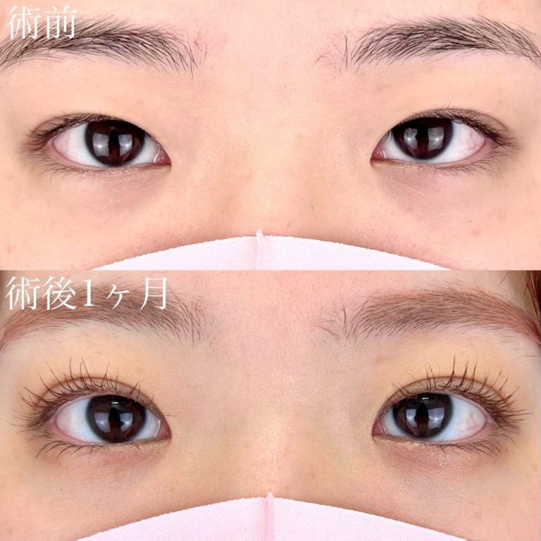 二重埋没法(担当医:TCB 医師)の症例写真1