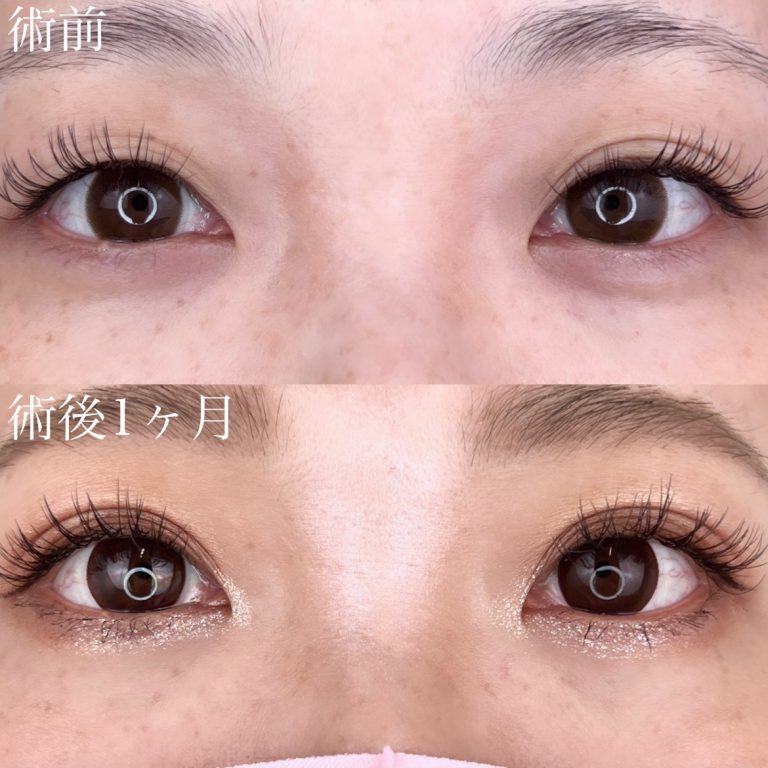 二重埋没法(担当医:TCB 医師)の症例写真1