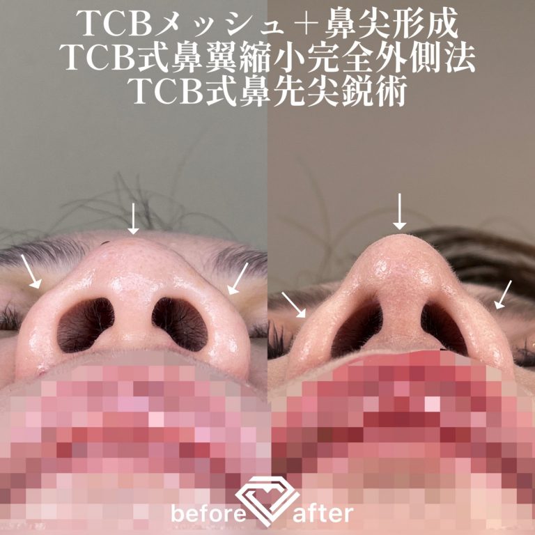 TCB式鼻先尖鋭術（だんご鼻解消）(担当医:TCB 医師)の症例写真1