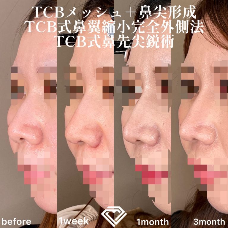 TCB式鼻先尖鋭術（だんご鼻解消）(担当医:TCB 医師)の症例写真3