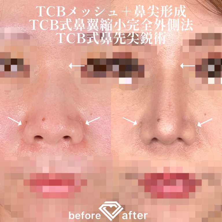 TCB式鼻先尖鋭術（だんご鼻解消）(担当医:TCB 医師)の症例写真4