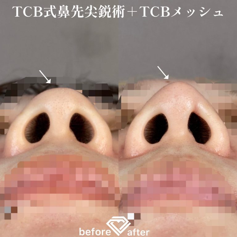 TCB式鼻先尖鋭術（だんご鼻解消）(担当医:森本 理一郎 医師)の症例写真1