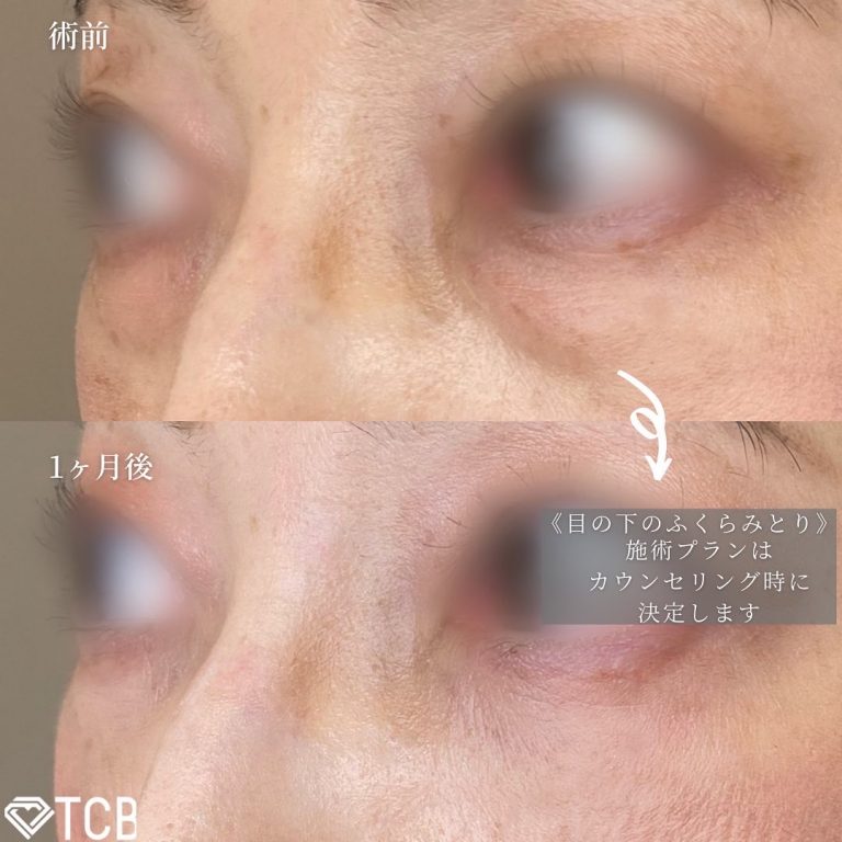 切らない目の下のクマ取り・目の下のたるみ（ふくらみ）取り(担当医:TCB 医師)の症例写真3