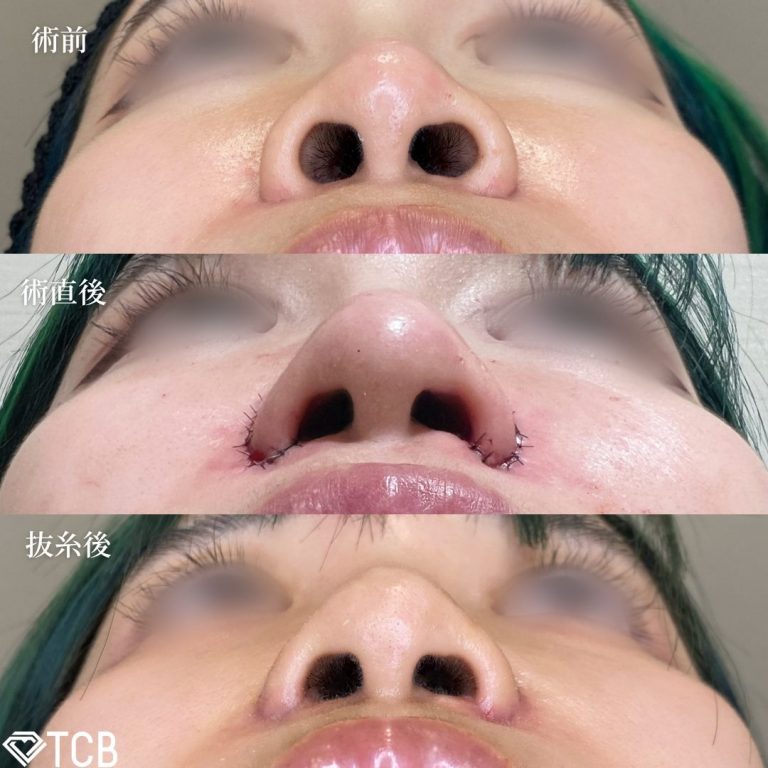 TCB式鼻翼縮小完全内側法(担当医:TCB 医師)の症例写真3