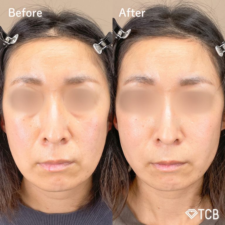 TCB式小顔美肌再生(担当医:岡本 卓也 医師)の症例写真1