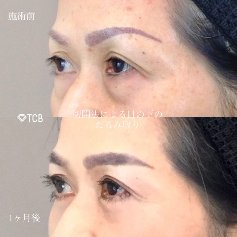 切開法による目の下のたるみ取り（下眼瞼除皺術）(担当医:佐藤 麻未 医師)の症例写真2