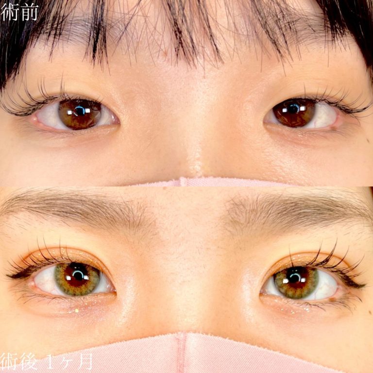 二重埋没法(担当医:TCB 医師)の症例写真1