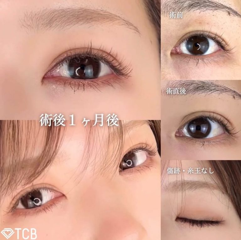 二重埋没法(担当医:TCB 医師)の症例写真1