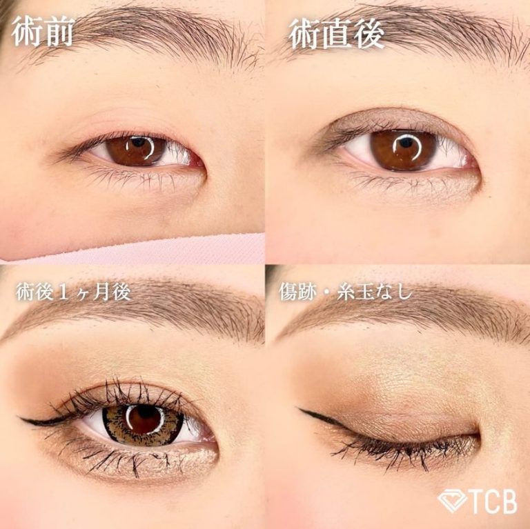 二重埋没法(担当医:TCB 医師)の症例写真1