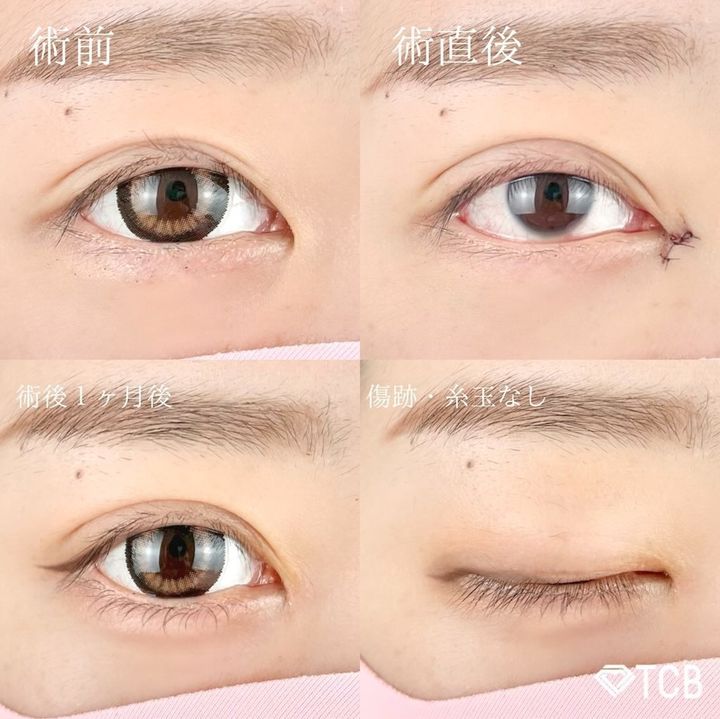 二重埋没法(担当医:TCB 医師)の症例写真1