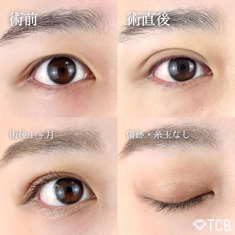 二重埋没法(担当医:TCB 医師)の症例写真1