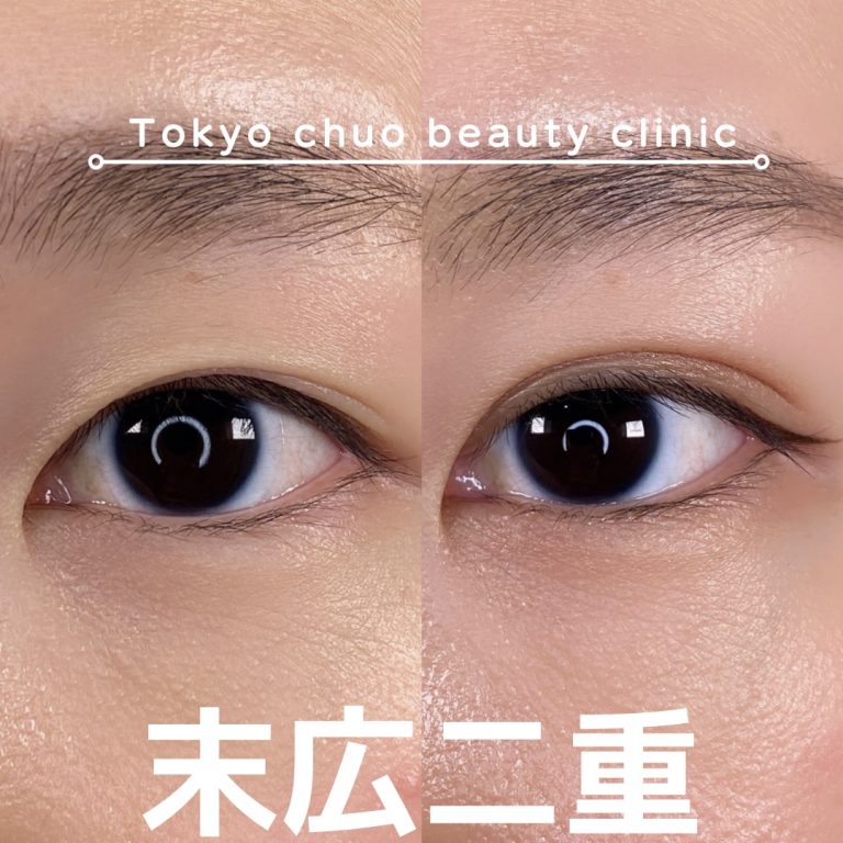 二重埋没法(担当医:TCB 医師)の症例写真1