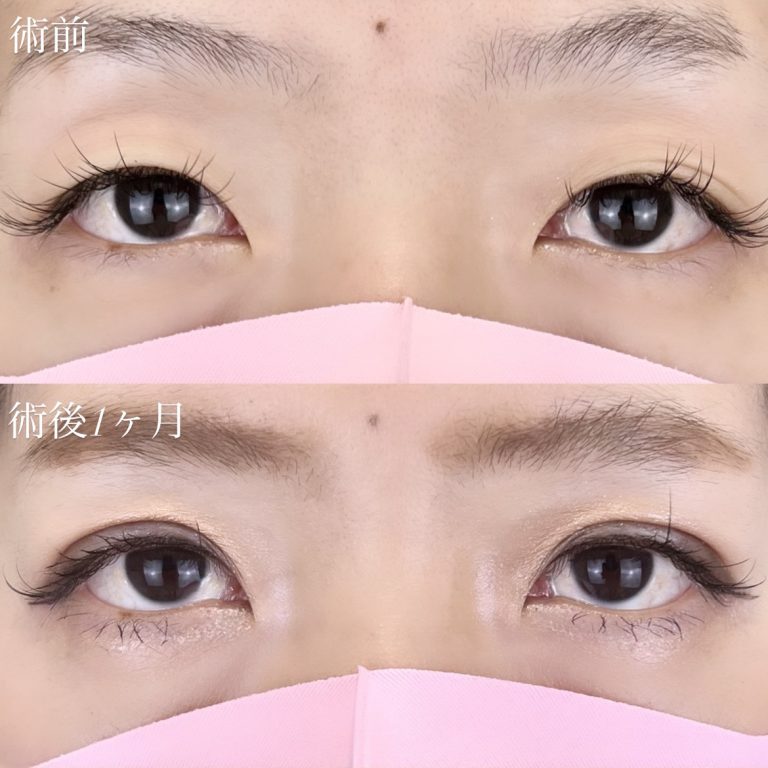 二重埋没法(担当医:TCB 医師)の症例写真1