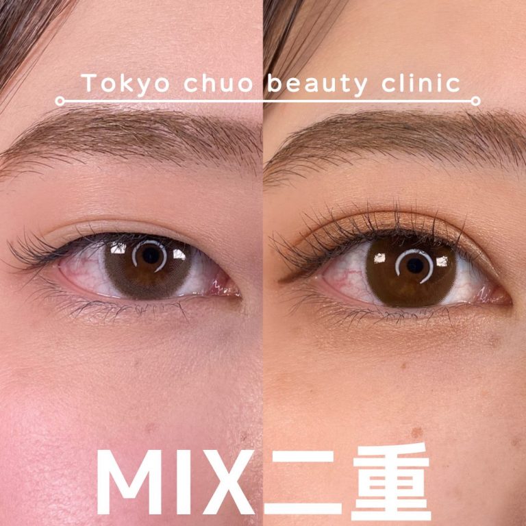 二重埋没法(担当医:TCB 医師)の症例写真1