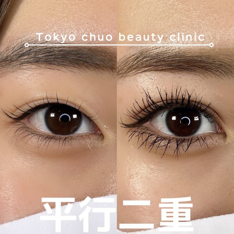 二重埋没法(担当医:TCB 医師)の症例写真1