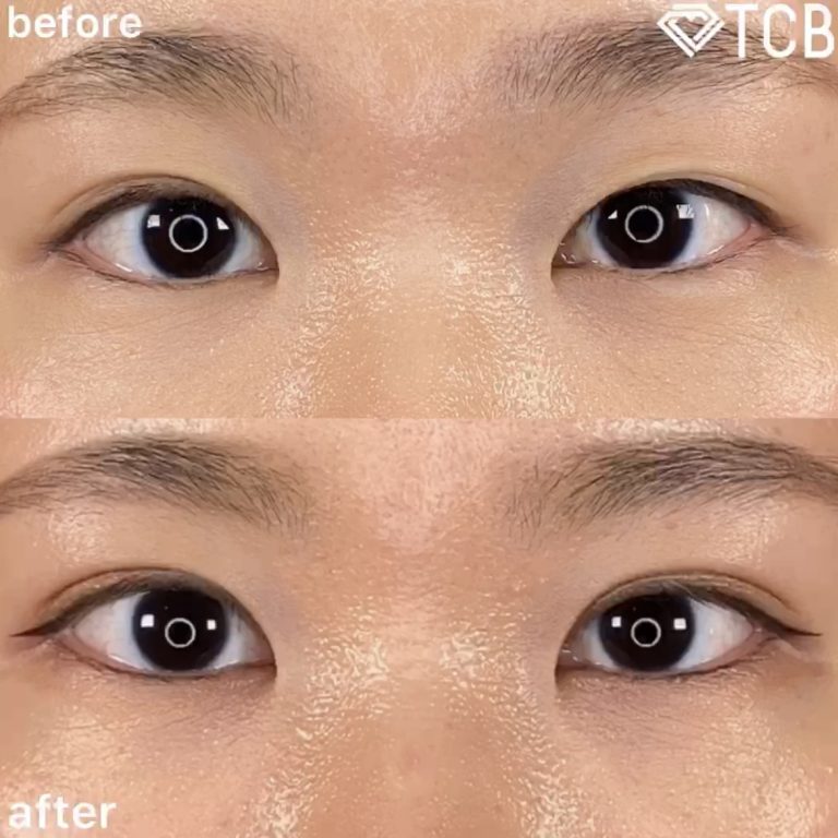 二重埋没法(担当医:TCB 医師)の症例写真2