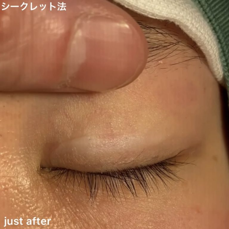 二重埋没法(担当医:TCB 医師)の症例写真3