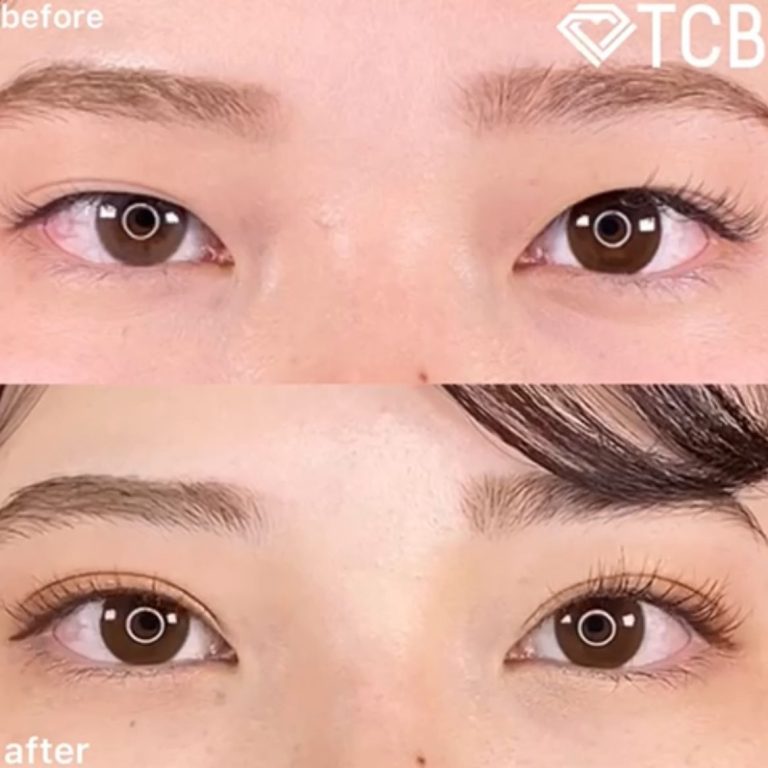 二重埋没法(担当医:TCB 医師)の症例写真2
