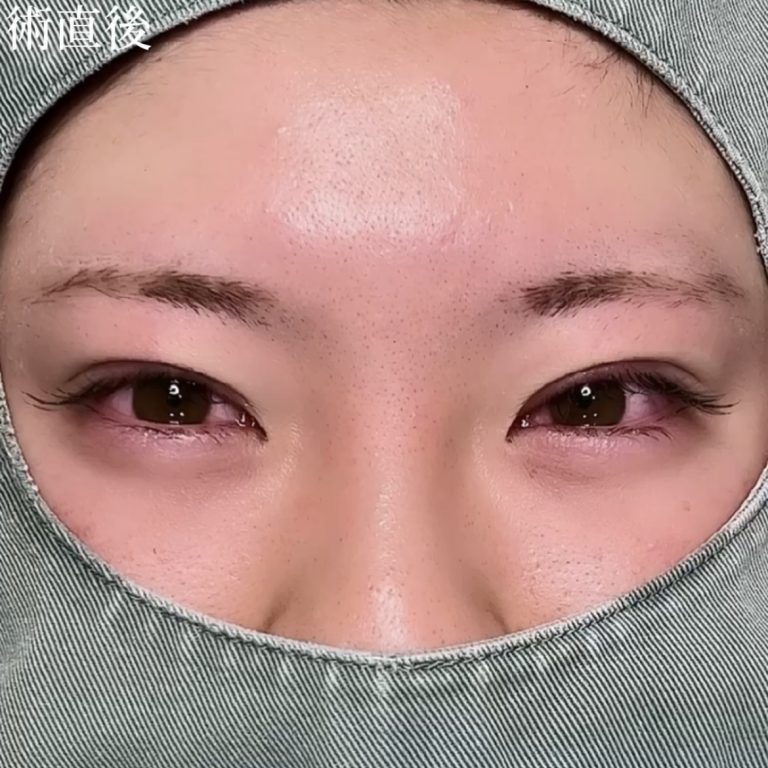二重埋没法(担当医:TCB 医師)の症例写真3