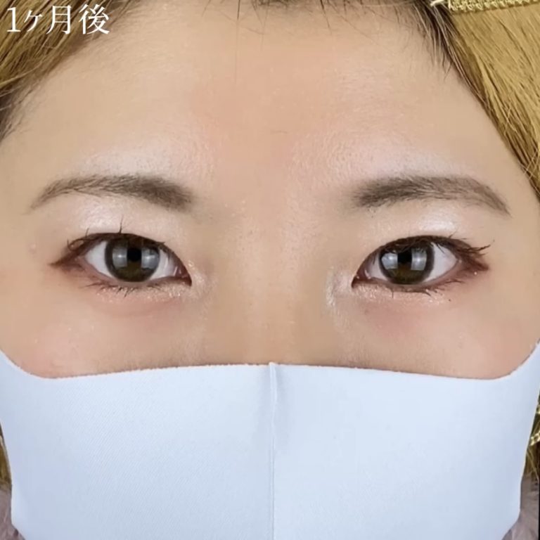 二重埋没法(担当医:TCB 医師)の症例写真4