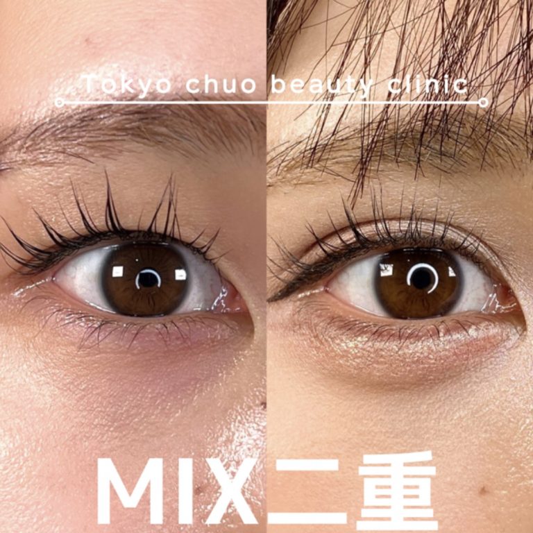 二重埋没法(担当医:TCB 医師)の症例写真1