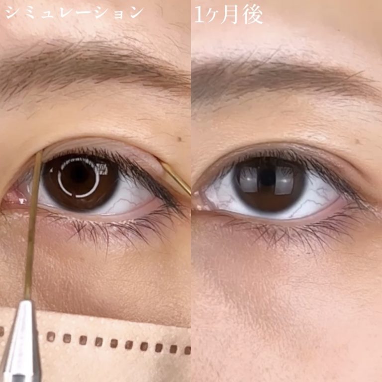 二重埋没法(担当医:TCB 医師)の症例写真2