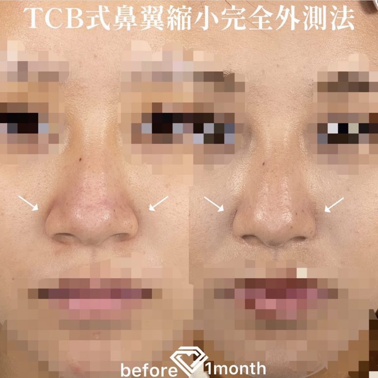 TCB式鼻翼縮小完全内側法・外側法(担当医:TCB 医師)の症例写真1