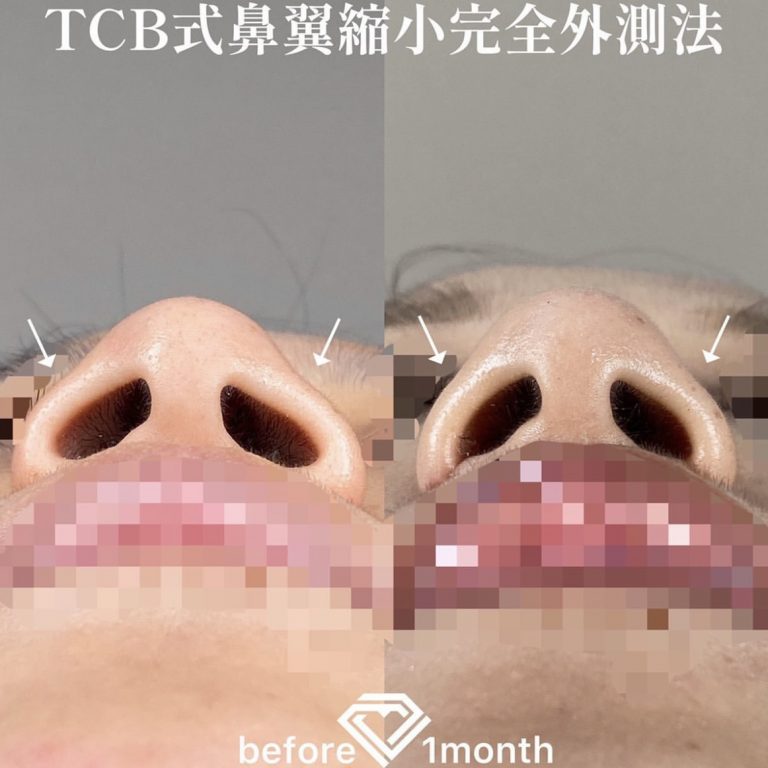 TCB式鼻翼縮小完全内側法・外側法(担当医:TCB 医師)の症例写真3