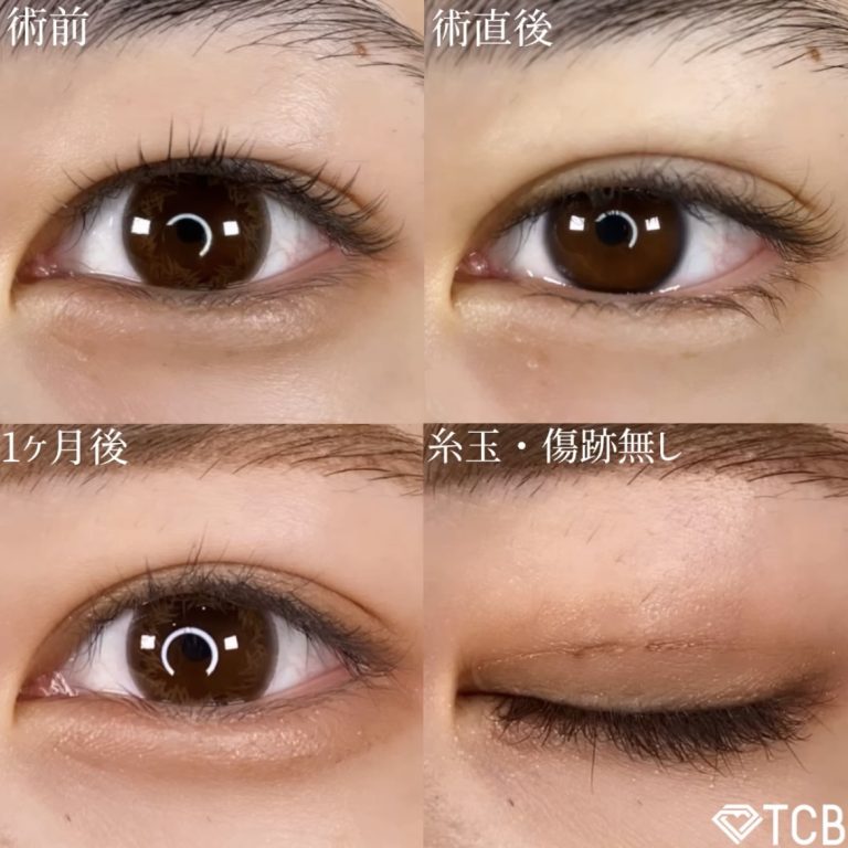 二重埋没法(担当医:TCB 医師)の症例写真1