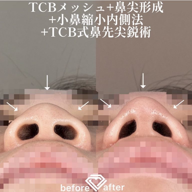 TCBメッシュ(担当医:森本 理一郎 医師)の症例写真4